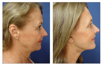 Rhinoplasty Washington DC Supports Functional and Aesthetic Goals